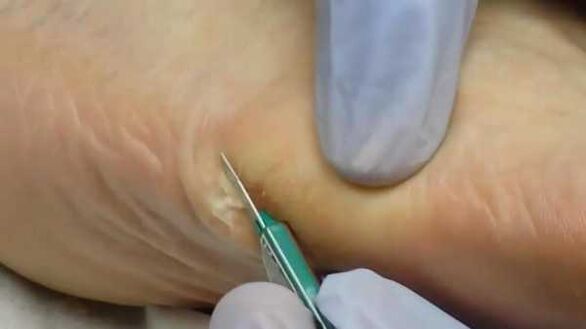 Extirpación quirúrgica de una verruga plantar