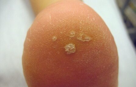 Πώς να αναγνωρίσετε ένα κονδυλωτό Pierce