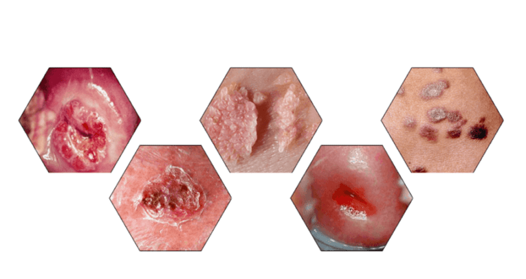 Γιατί είναι επικίνδυνα τα θηλώματα;