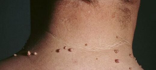 πώς να απαλλαγείτε από τα θηλώματα