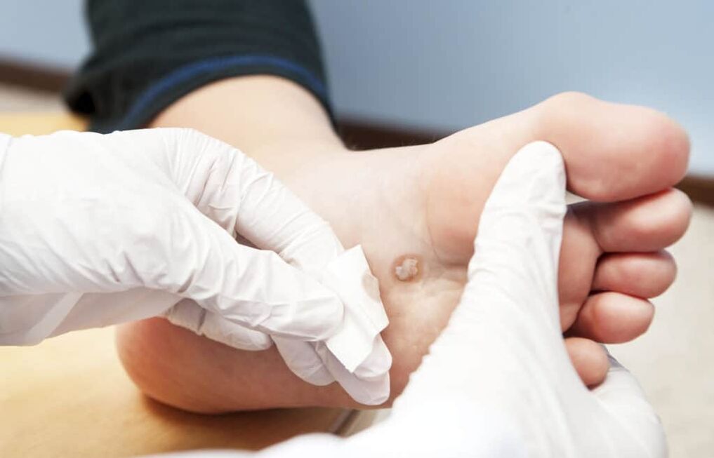 γιατί εμφανίζονται κονδυλώματα στο σώμα